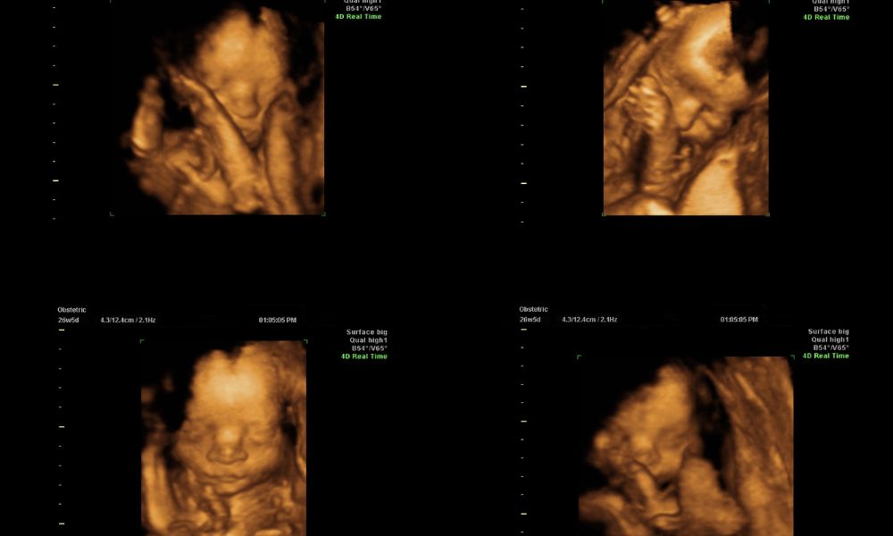 How Much Is a 3D Ultrasound? Cost and Other Considerations